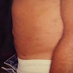Liposuction Male Before & After Patient #2915