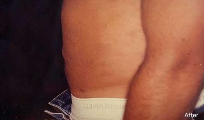 Liposuction Male Before & After Patient #2915