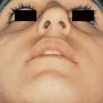 Rhinoplasty Before & After Patient #3000