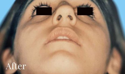 Rhinoplasty Before & After Patient #3000