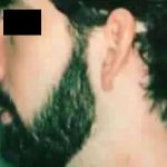 Rhinoplasty Male Before & After Patient #3036