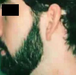 Rhinoplasty Male Before & After Patient #3036