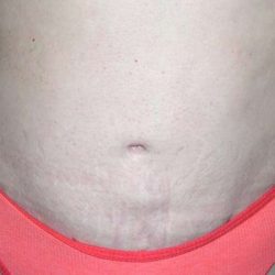 Tummy Tuck Before & After Patient #3075