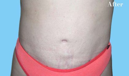Tummy Tuck Before & After Patient #3075