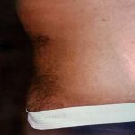Tummy Tuck Male Before & After Patient #3087
