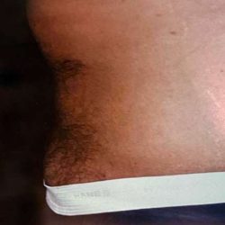 Tummy Tuck Male Before & After Patient #3087