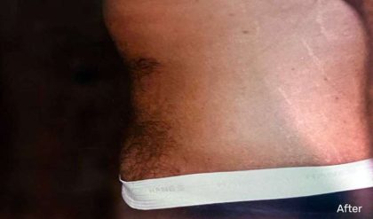 Tummy Tuck Male Before & After Patient #3087