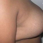 Breast Reduction Before & After Patient #2360