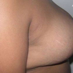 Breast Reduction Before & After Patient #2360