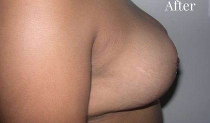 Breast Reduction Before & After Patient #2360