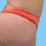 Buttock Augmentation Before & After Patient #2456