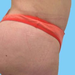 Buttock Augmentation Before & After Patient #2456