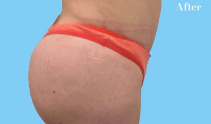Buttock Augmentation Before & After Patient #2456