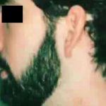 Chin Implants Before & After Patient #2480