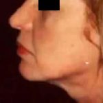 Chin Liposuction Before & After Patient #2492