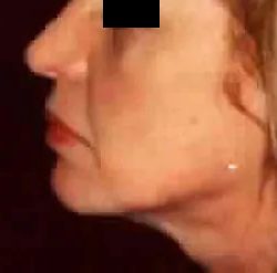 Chin Liposuction Before & After Patient #2492