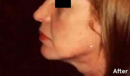 Chin Liposuction Before & After Patient #2492