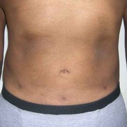 Daddy Makeover Before & After Patient #2524