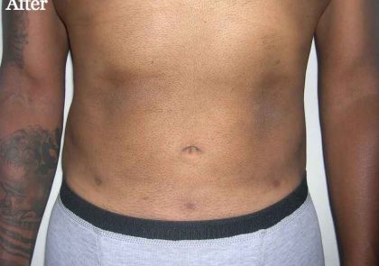 Daddy Makeover Before & After Patient #2524