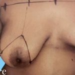 Breast Asymmetry Correction Before & After Patient #2184