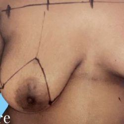 Breast Asymmetry Correction Before & After Patient #2184