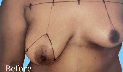 Breast Asymmetry Correction Before & After Patient #2184