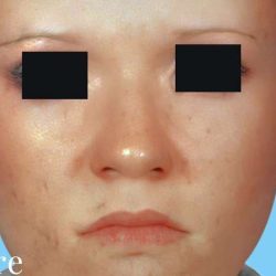 Otoplasty Before & After Patient #2559