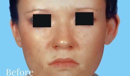 Otoplasty Before & After Patient #2559