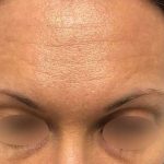 Eyebrow Restoration Before & After Patient #2594