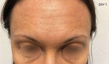 Eyebrow Restoration Before & After Patient #2594