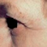 Eyelid Surgery Before & After Patient #2623