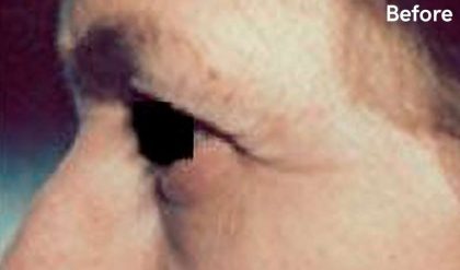Eyelid Surgery Before & After Patient #2623