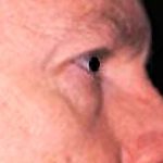 Eyelid Surgery Male Before & After Patient #2635