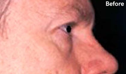 Eyelid Surgery Male Before & After Patient #2635