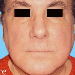 Facelift Male Before & After Patient #2671
