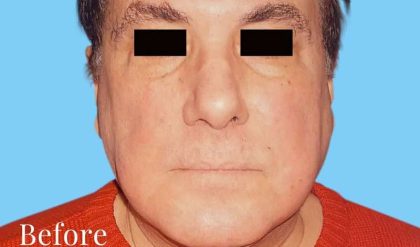 Facelift Male Before & After Patient #2671