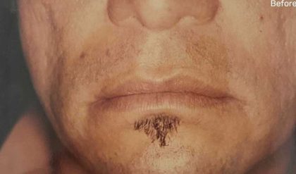 Fat Transfer Male Before & After Patient #2692