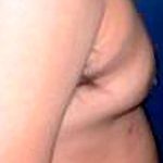 Gynecomastia Before & After Patient #2719
