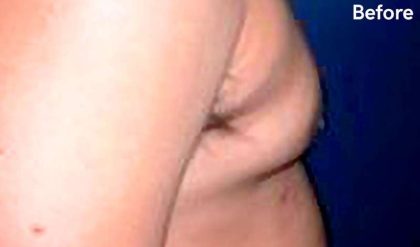 Gynecomastia Before & After Patient #2719