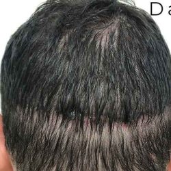 Hair Restoration Before & After Patient #2799