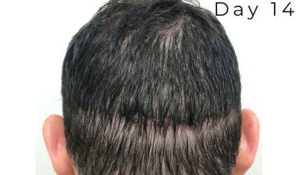 Hair Restoration Before & After Patient #2799