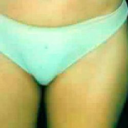 Liposuction Before & After Patient #2882