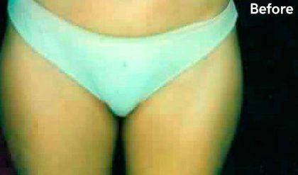 Liposuction Before & After Patient #2882