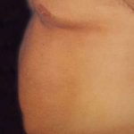 Liposuction Male Before & After Patient #2915