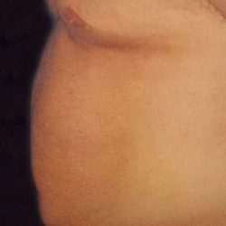 Liposuction Male Before & After Patient #2915