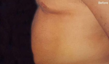 Liposuction Male Before & After Patient #2915