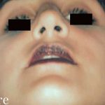 Rhinoplasty Before & After Patient #3000