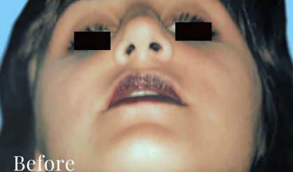 Rhinoplasty Before & After Patient #3000