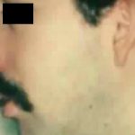 Rhinoplasty Male Before & After Patient #3036