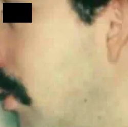 Rhinoplasty Male Before & After Patient #3036